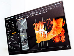 Digital Xrays